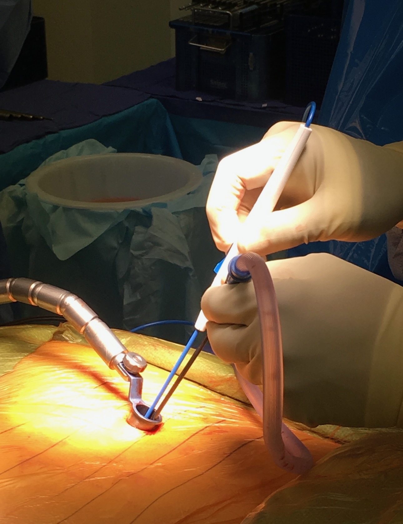 Close-up of minimally invasive spine surgery technique